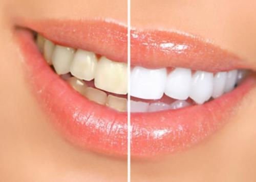Bright White Smiles 44% Teeth Whitening Gel Syringe Refill Pack, Carbamide Peroxide, 5 Syringes (3ml),Tooth Whitener Formula